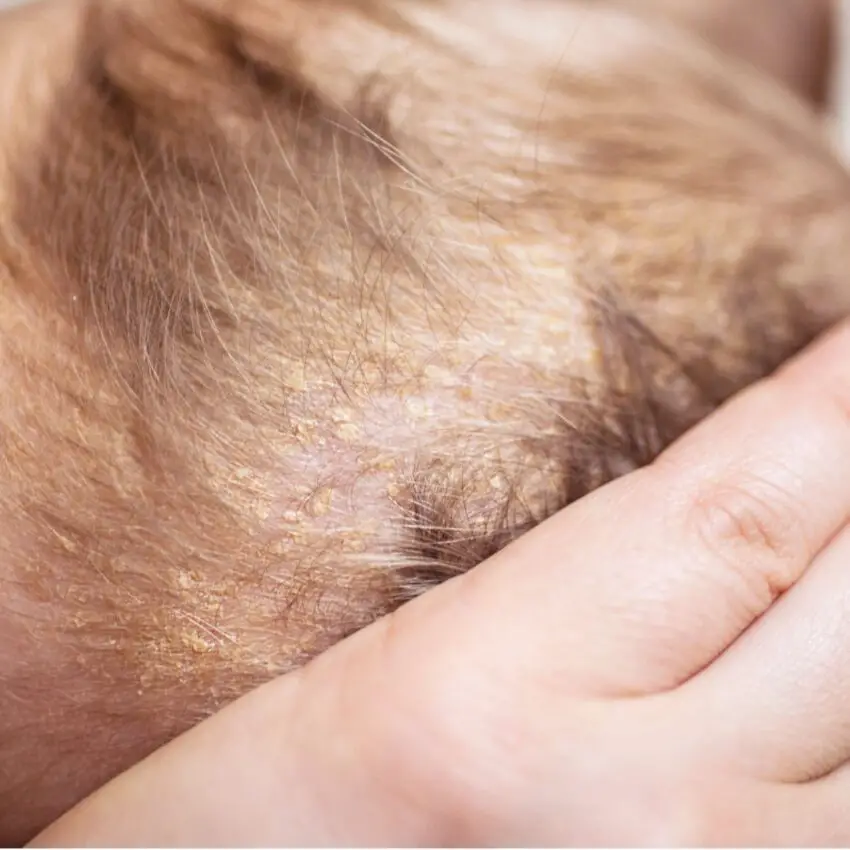 Seborrheic dermatitis in infants