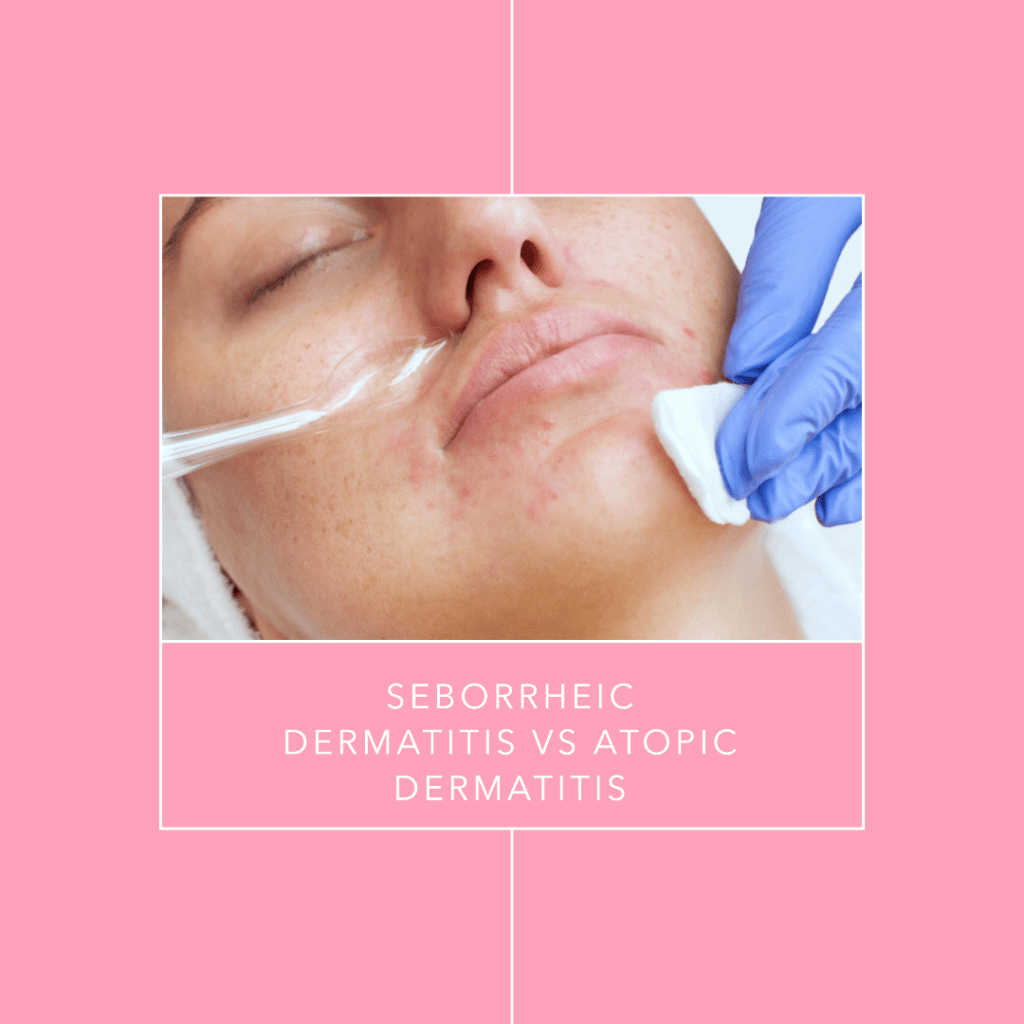 seborrheic dermatitis vs atopic dermatitis how to know the difference