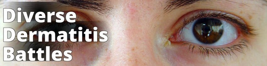 File:Microphthalmia1.jpg - a woman with brown eyes and long eyelashes