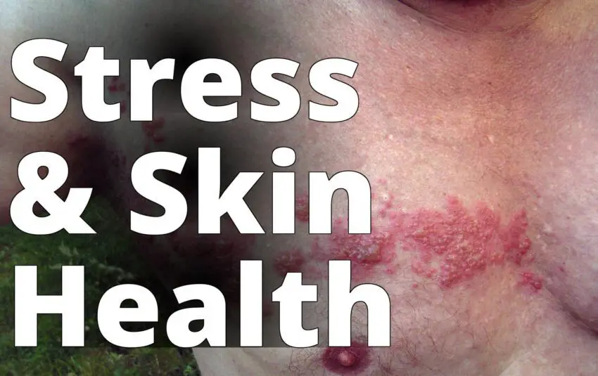 Herpes zoster chest - a man with a rash on his chest