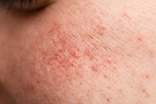 Saltwater Secrets: How to effectively treat Seborrheic Dermatitis on your skin, scalp, and hair