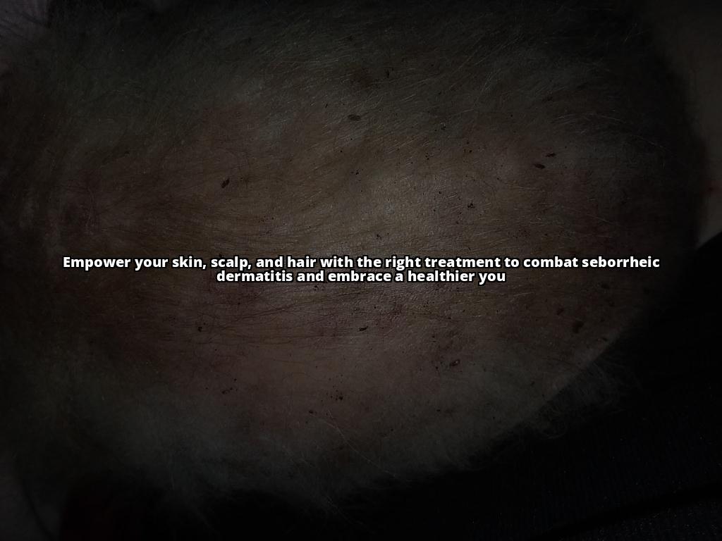 Seborrheic Dermatitis and Hormonal Changes: What You Need to Know