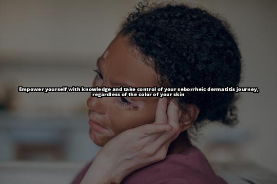 Seborrheic Dermatitis in Diverse Populations: Understanding the Condition and Treatment Options