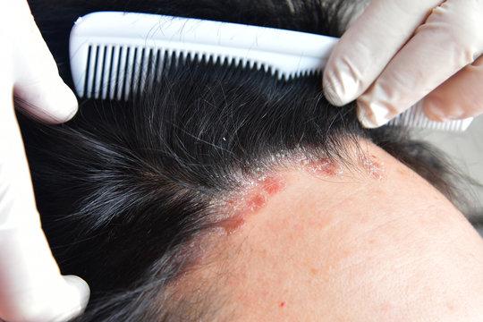 Psoriasis. Hairy part of the head. Plasma injection. Treatment of zabolivanie plasma human blood. -