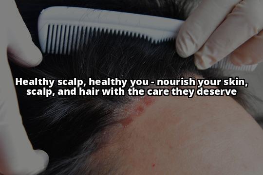 Seborrheic Dermatitis and Scalp Buildup: Your Complete Guide to a Healthy Scalp