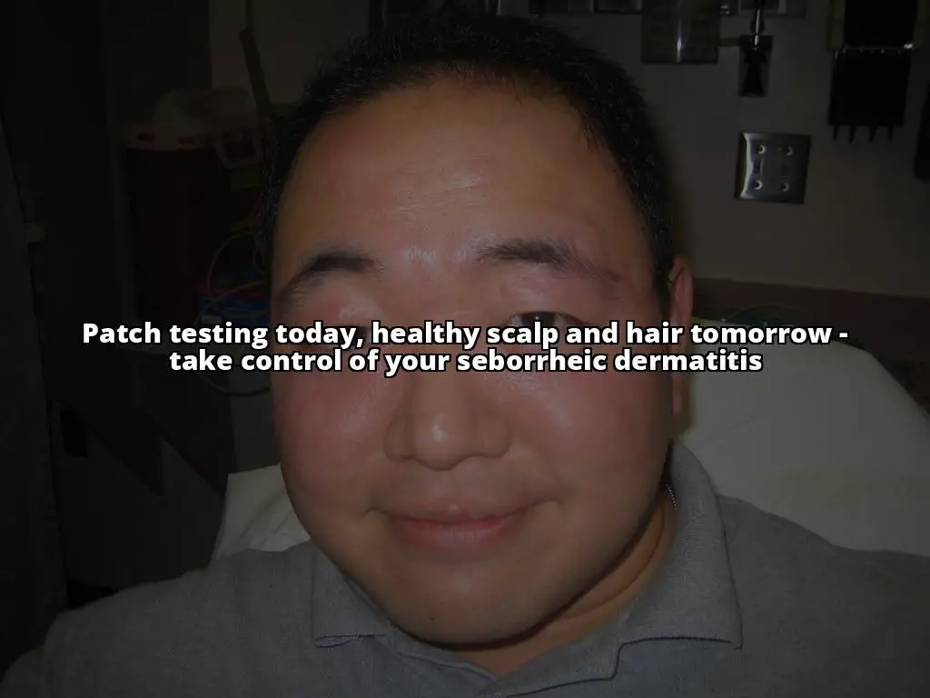 The Ultimate Guide to Patch Testing for Seborrheic Dermatitis Relief