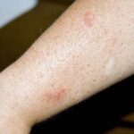 allergic reaction - a person with a white rash on their arm