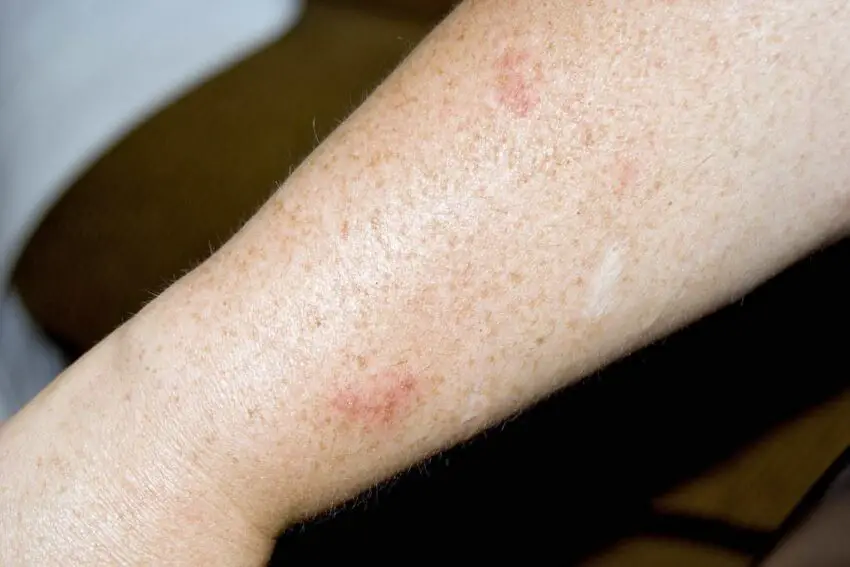 allergic reaction - a person with a white rash on their arm