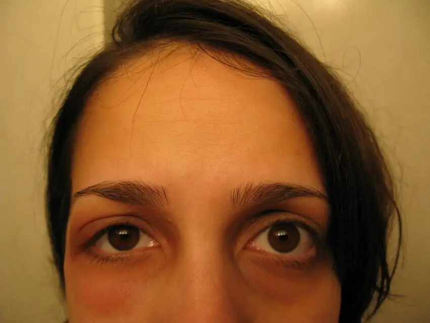 spider bite/allergic reaction/infection all w/in 24 hr. - a woman with a tooth brush in her mouth