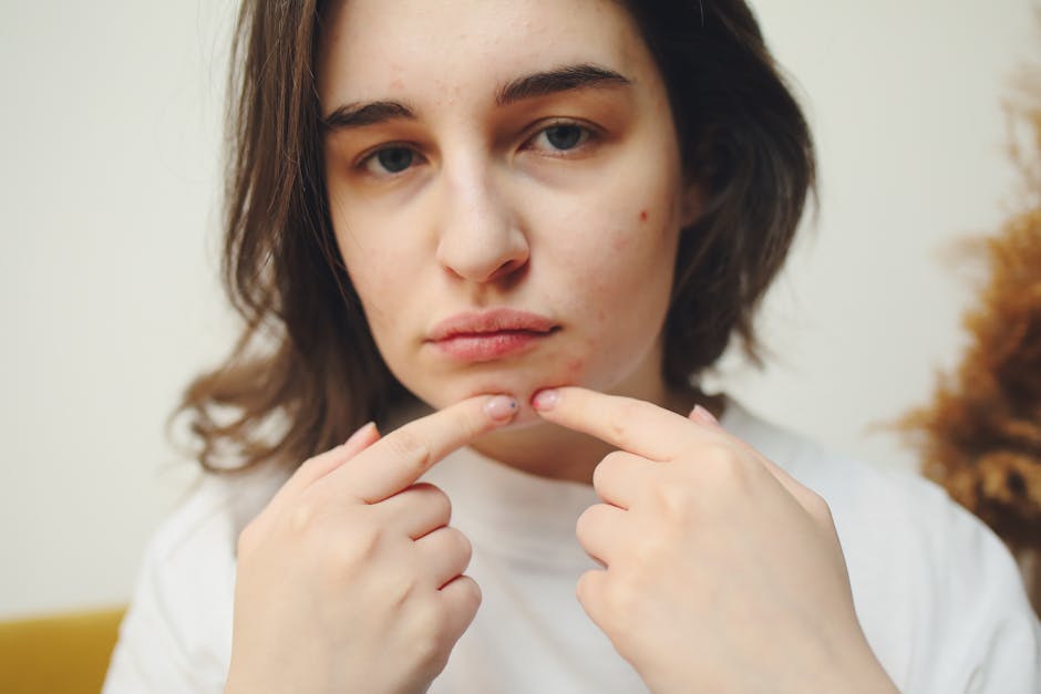 Can Seborrheic Dermatitis Cause Acne? The Truth Revealed - pimple acne face woman