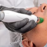 Seborrheic Dermatitis and Stress Management: Breaking the Flare Cycle (2026) - A close-up of a man receiving a professional skincare treatment in a clinical setting.